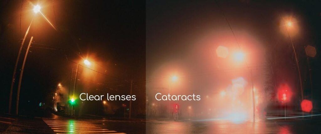 7 Early Signs to Know You Need Cataract Surgery